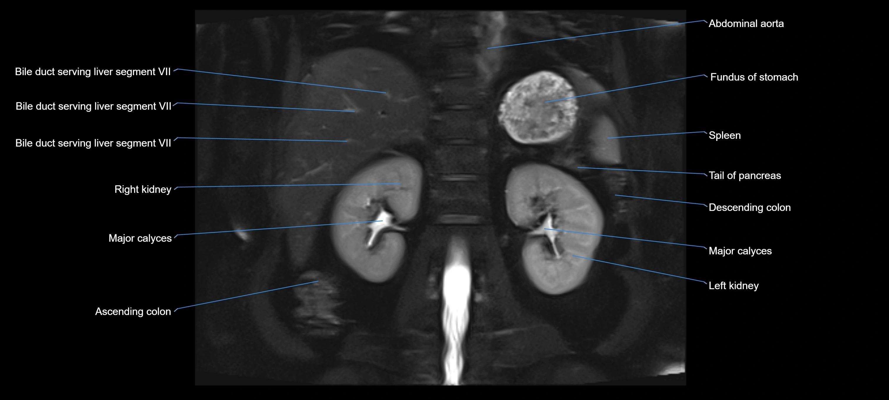 MRI MRCP coronal cross sectional 3T radiology  image-img-00001-00020.webp